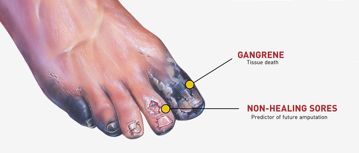 Diabetes and Amputation: A Matter of Life and Limb